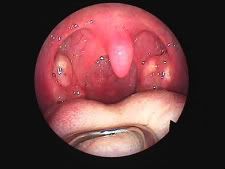 Tonsil Stones